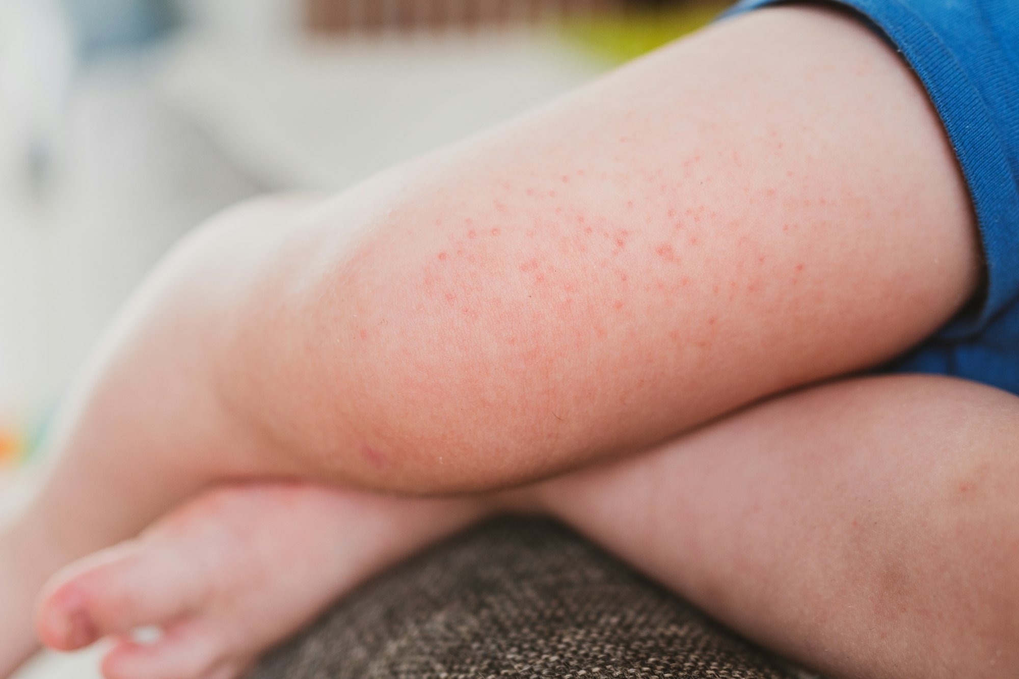 food allergies, eczema, or diathesis in a small child on the legs.